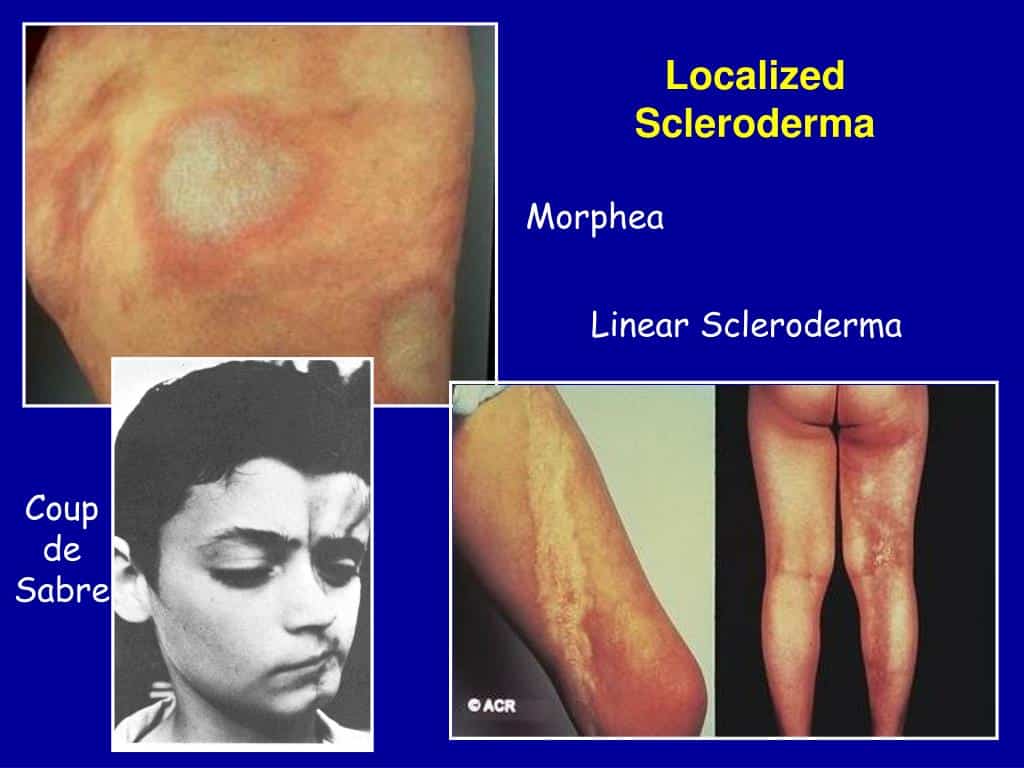 Morphea (Localized Scleroderma)
