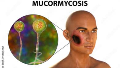 Mucormycosis (Black Fungus)