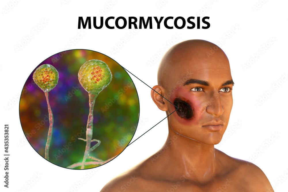 Mucormycosis (Black Fungus)