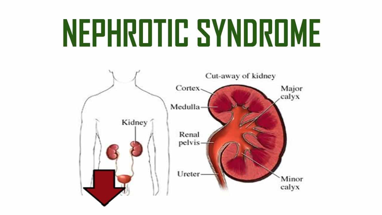 Nephritic Syndrome
