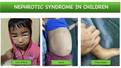 Nephrotic Syndrome