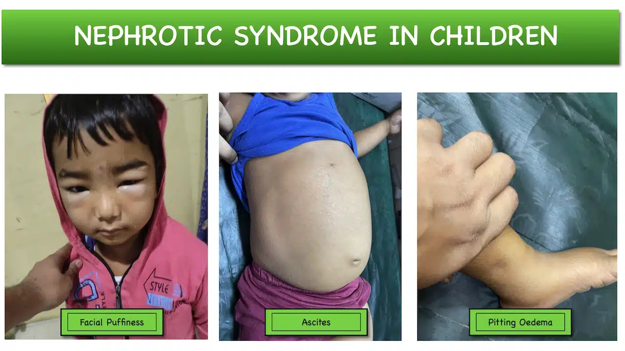 Nephrotic Syndrome