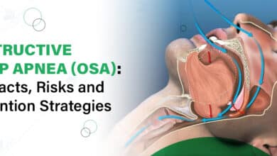Obstructive Sleep Apnea