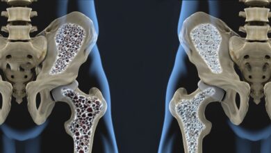 Osteoporosis