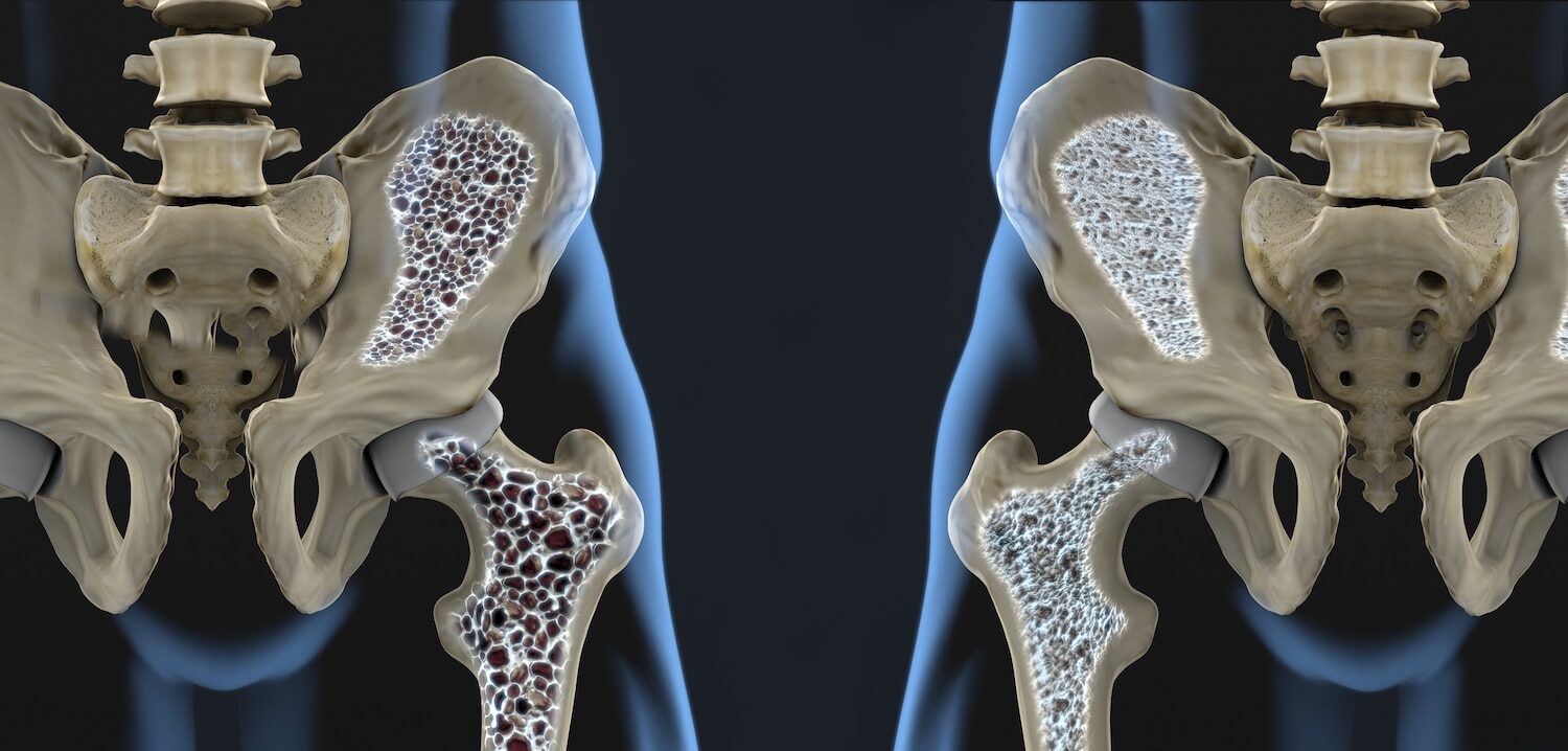 Osteoporosis