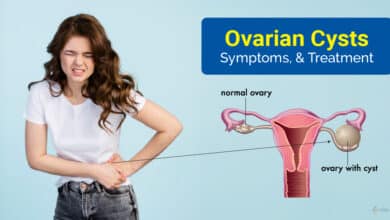 Ovarian Cysts