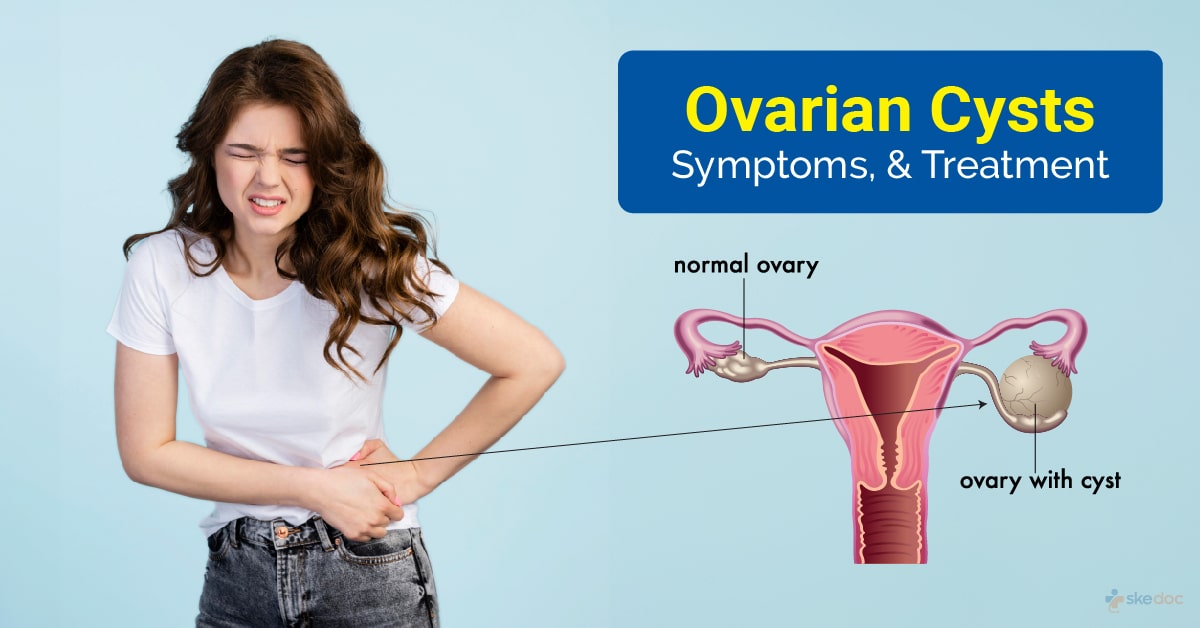 Ovarian Cysts