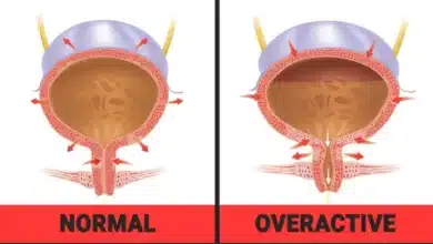 Overactive Bladder