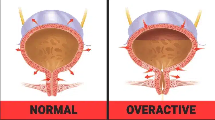 Overactive Bladder