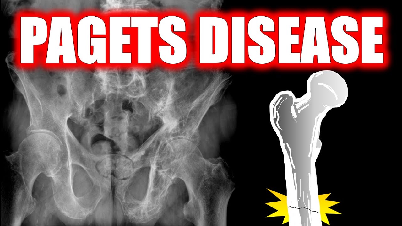 Paget's Disease of Bone