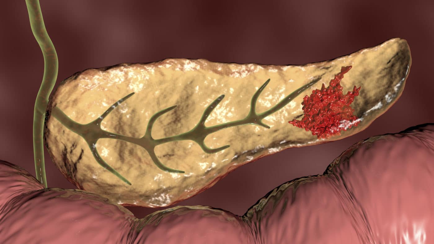 Pancreatic Cancer