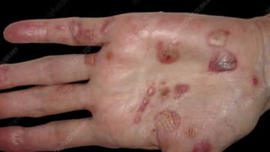 Pemphigus Vulgaris
