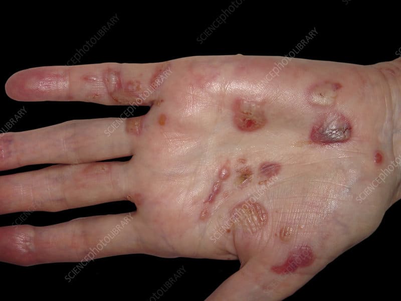 Pemphigus Vulgaris
