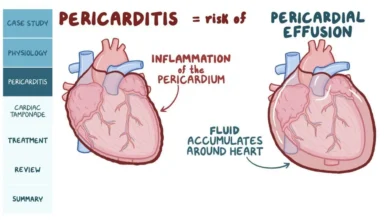 Pericarditis and Myocarditis