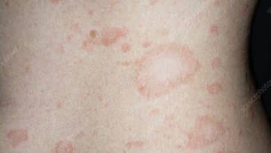 Pityriasis Rosea