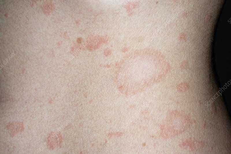 Pityriasis Rosea