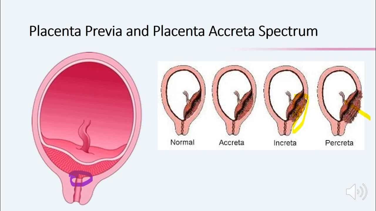 Placenta Previa and Placenta Accreta