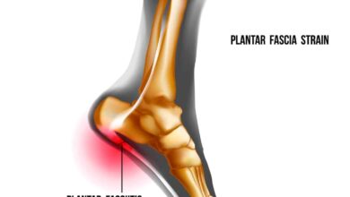 Plantar Fasciitis