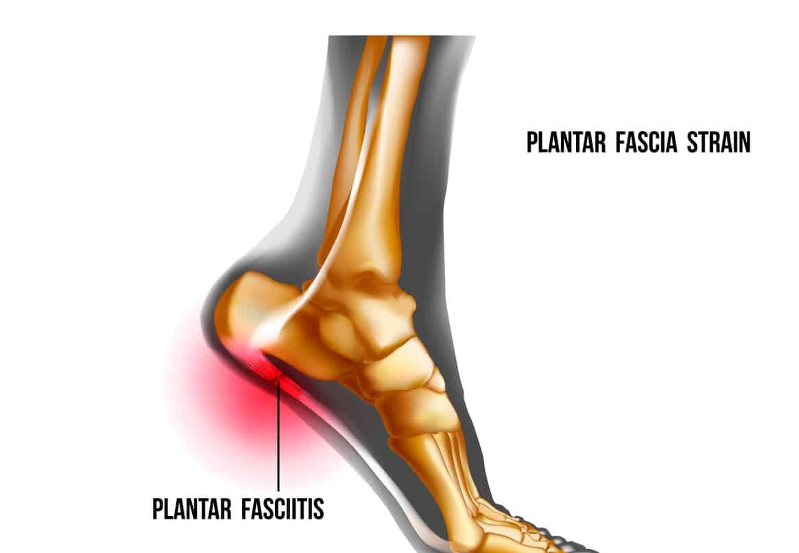 Plantar Fasciitis