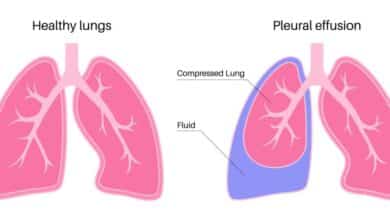 Pleural Effusion