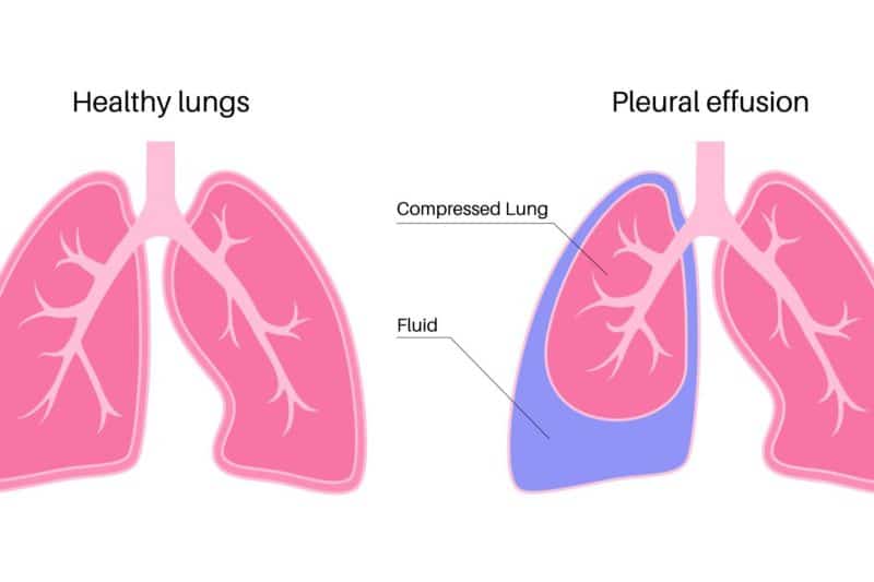 Pleural Effusion