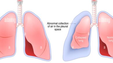 Pneumothorax