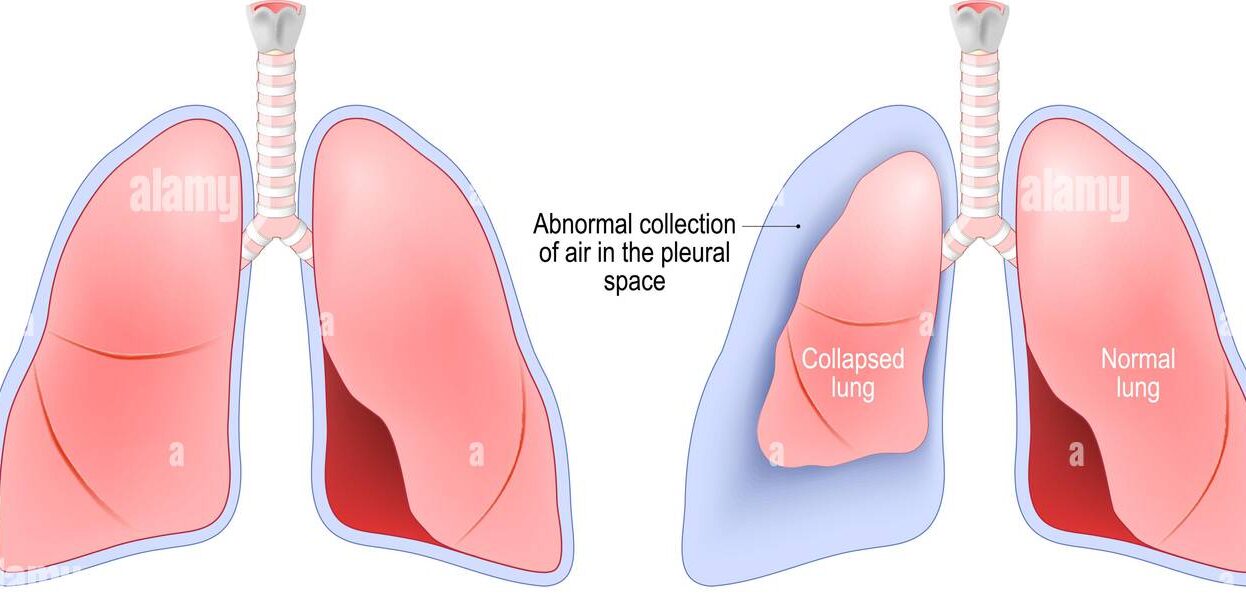Pneumothorax