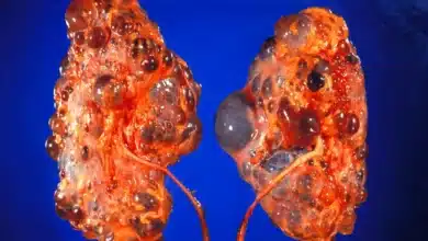 Polycystic Kidney Disease