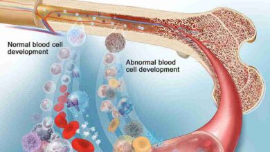 Myelodysplastic Syndrome