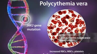 Polycythemia Vera
