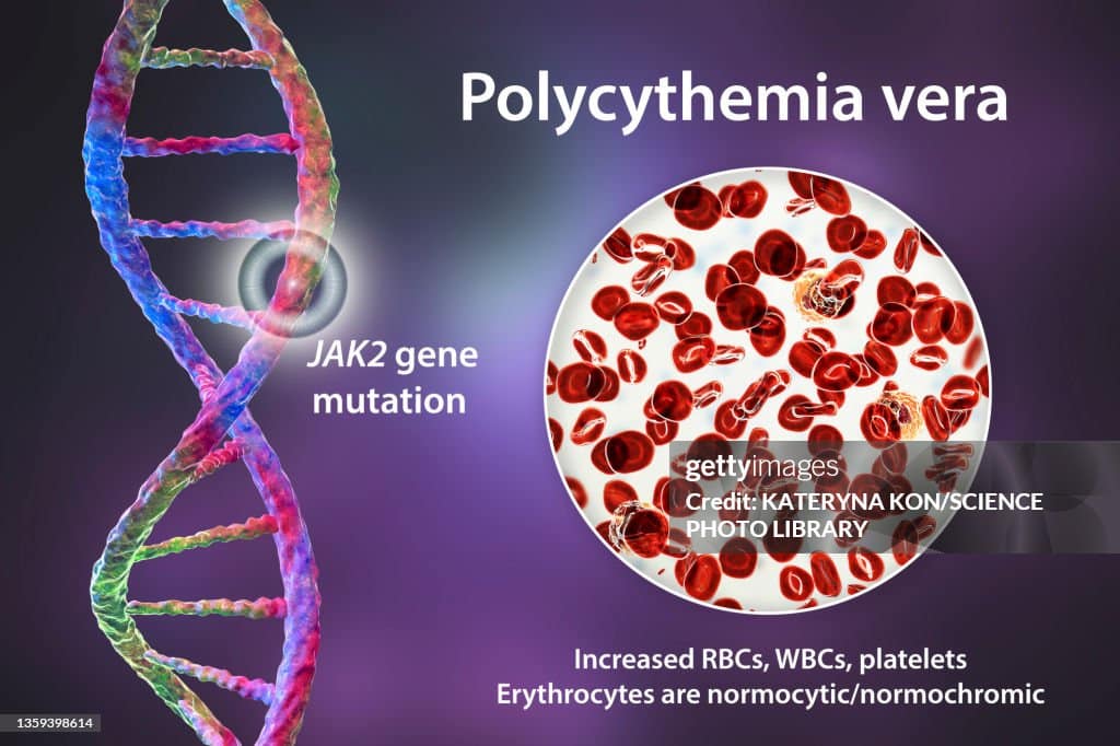 Polycythemia Vera