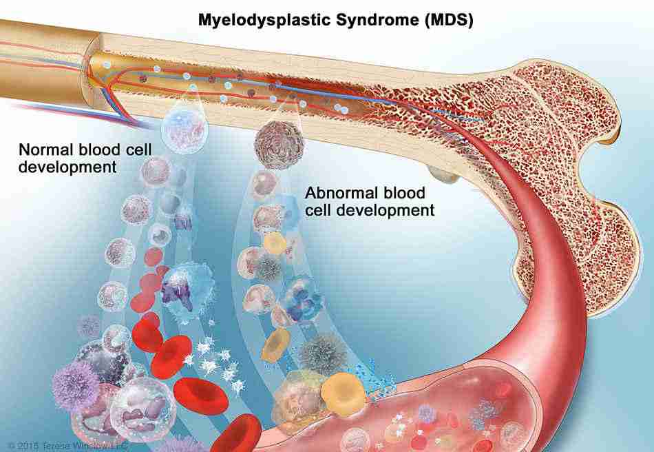 Myelodysplastic Syndrome