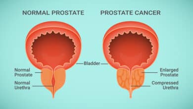 Prostate Cancer