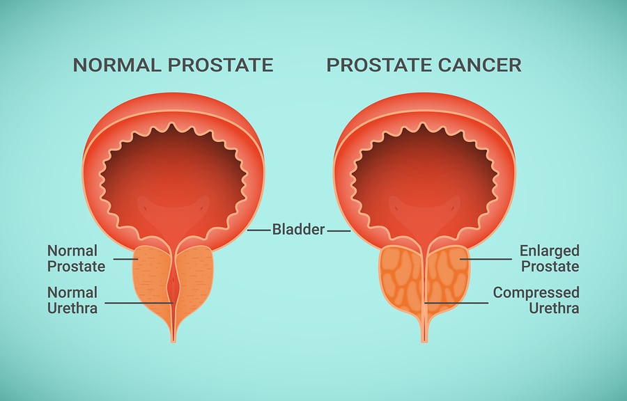 Prostate Cancer