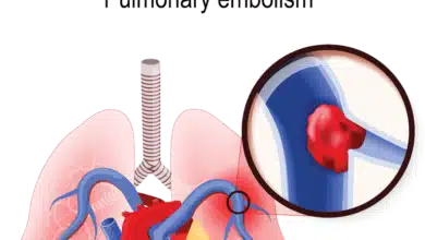 Pulmonary Embolism