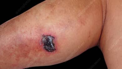 Pyoderma Gangrenosum