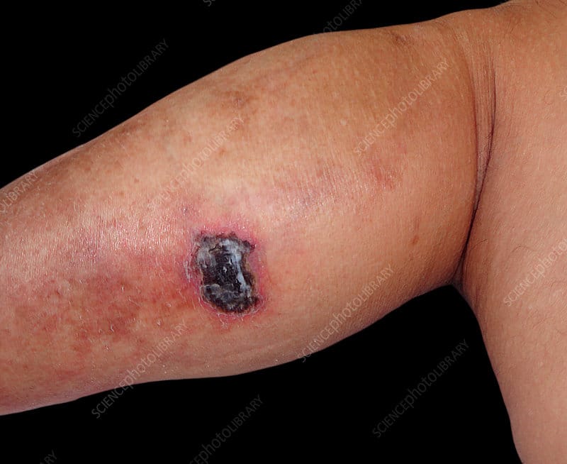 Pyoderma Gangrenosum