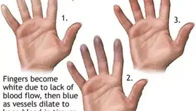 Raynaud's Phenomenon
