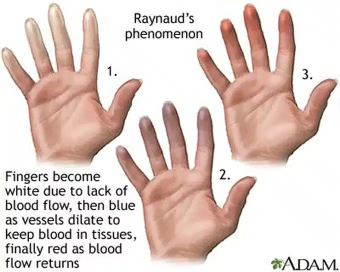 Raynaud's Phenomenon