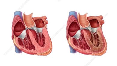 Restrictive Cardiomyopathy
