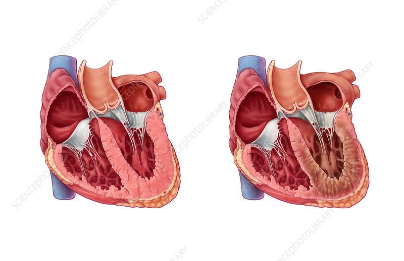 Restrictive Cardiomyopathy