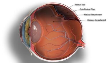 Retinal Detachment