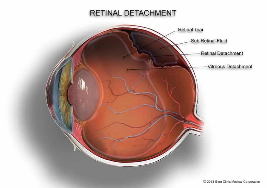 Retinal Detachment
