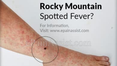 Rocky Mountain Spotted Fever