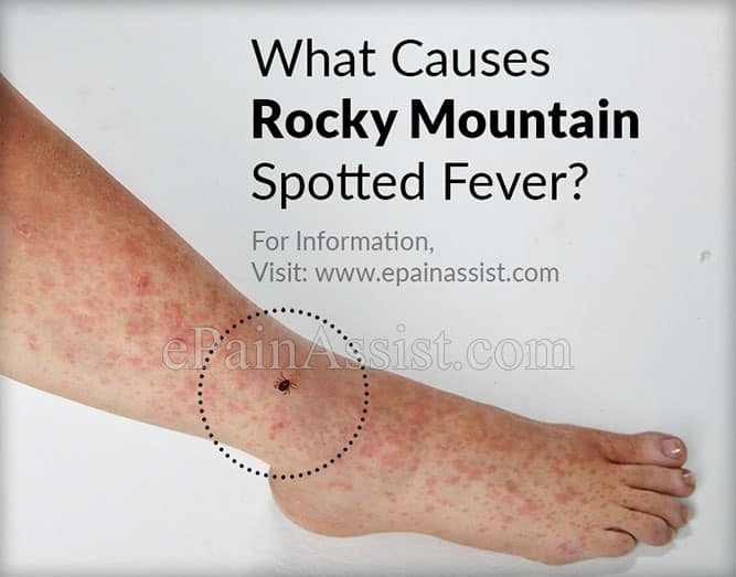 Rocky Mountain Spotted Fever