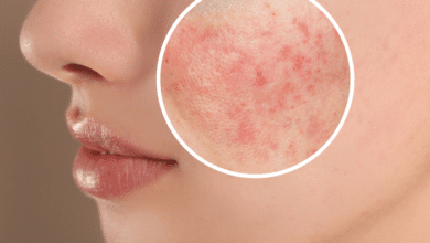 Rosacea