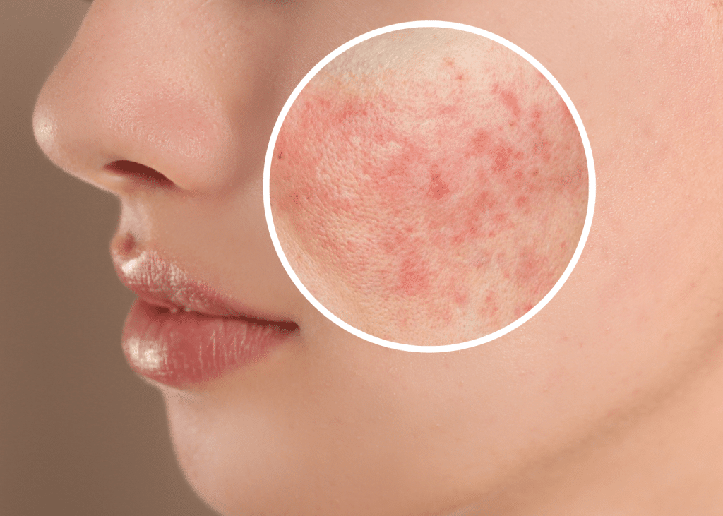 Rosacea