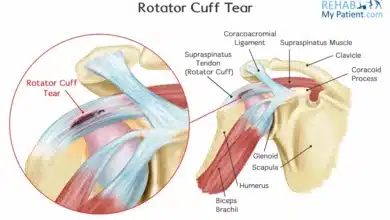 Rotator Cuff Tear