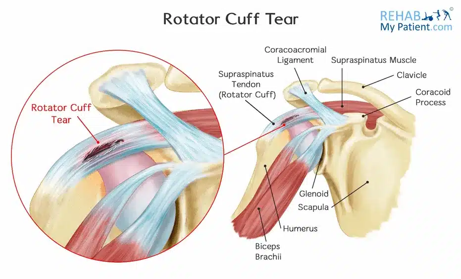 Rotator Cuff Tear