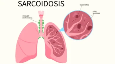 Sarcoidosis